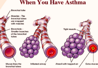 How You Get Asthma Image