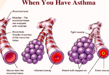 How You Get Asthma Photo Image