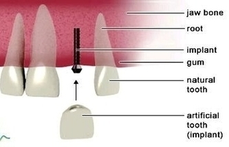 Immediate Load Implants Photo Image