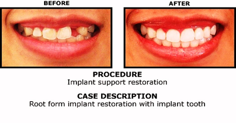 Implant Before And After Image