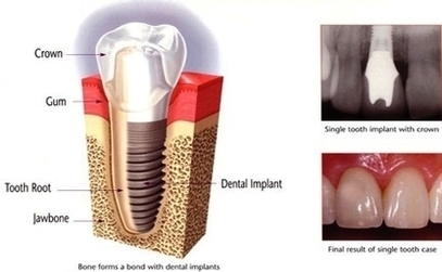 Implant Supported Replacement Teeth Image