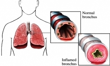 Inflammed Lung Asthma Image Image