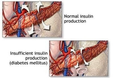 Insulin Production And Diabetes Image