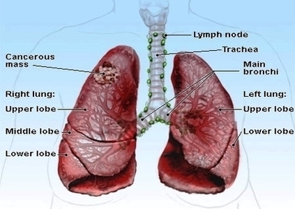 Lung Cancer Image