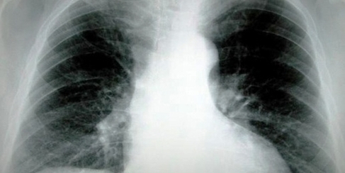 Lung Cancer Ray Image