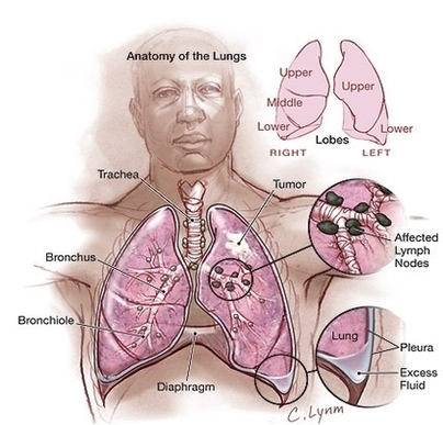 Lung Cancer Symptoms Image