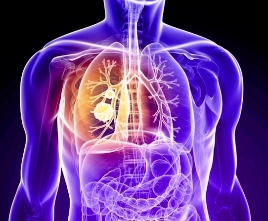 Lung Cancer Treatment Image