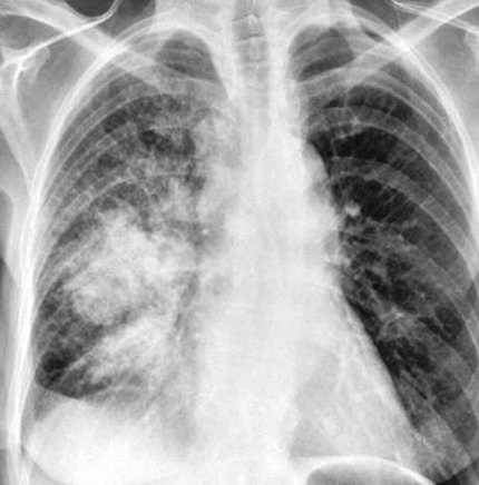 Lung Cancer Xray Image