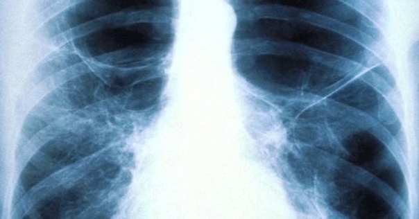 Lung Xray Ve Image