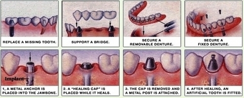 Marietta Ga Dental Implant Image