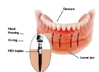 Mini Dental Implant Sanjuan Image