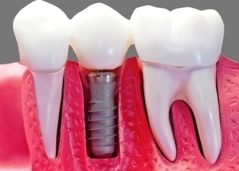 Mini Dental Implants Image