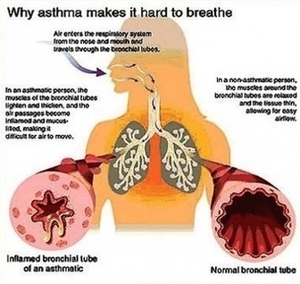 Natural Asthma Remedy Image