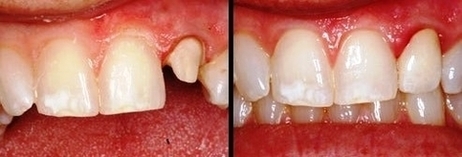 Ohmes Tooth Prepared For Crown Image