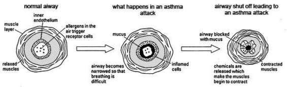 Pb Modelling The Human Ventilation System Asthma Image