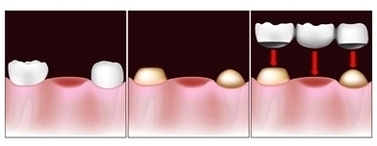 Pdm Dental Bridge Procedure Image