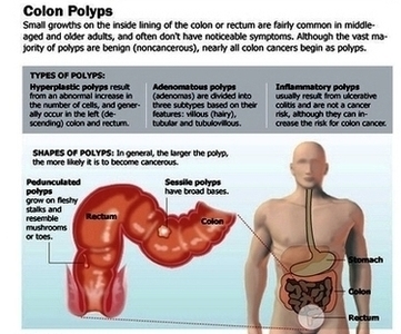 Photo Colon Polyps Lead Colon Cancers Image