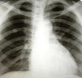 Photo Lung Cancer Ray Image