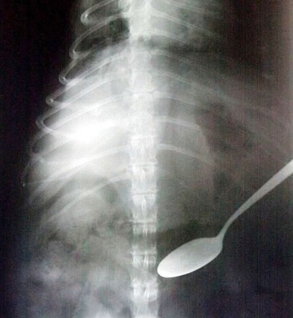 Pica Swallowed Spoon Ray Foreign Object Funny Image
