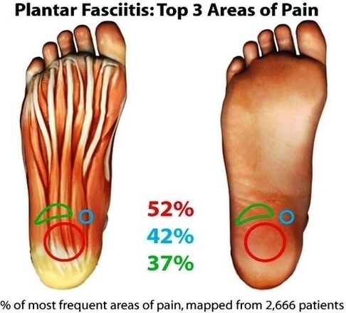 Plantar Fasciitis Pain Map Tt Tennis Warehouse Com Image