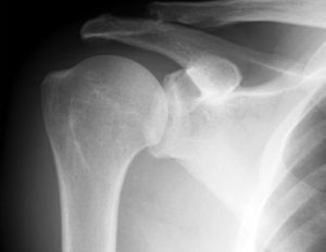 Posterior Shoulder Dislocation Image - Graph Diagram