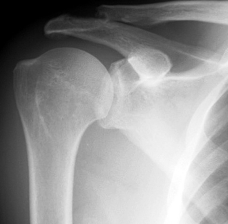 Posterior Shoulder Dislocation Image Image