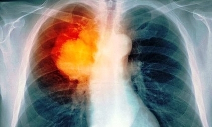 Princ Rm Lung Cancer Xray Image