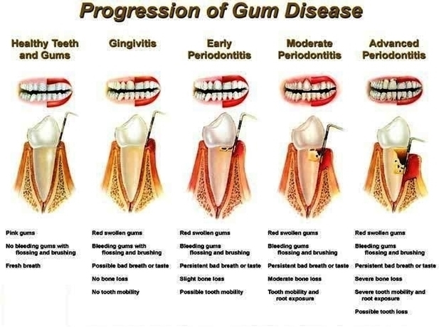 Progression Of Gum Disease Image