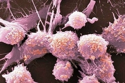 Prostate Cancer Cells Image
