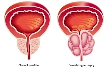 Prostate Cancer Image