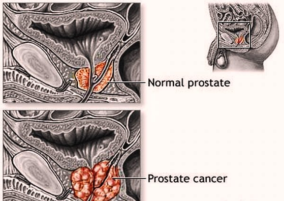 Prostate Cancer Rnkb Image