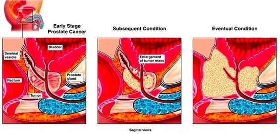 Prostate Cancer Symptoms Image