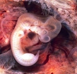 Px Tubal Pregnancy With Embryo Image