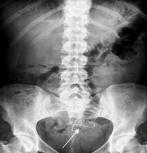 Ray Stomach Cancer Image