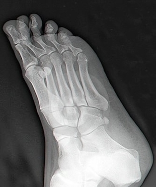 Right Foot Ray Thumb Image