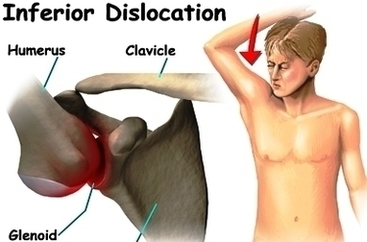 Shoulder Dislocation Anatomy Image