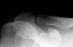 Normal Acj Interval Shoulder Xray Acj Normal Image