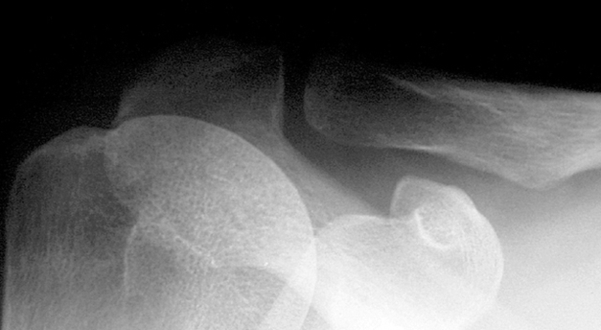 Shoulder Xray Acj Normaltures Image