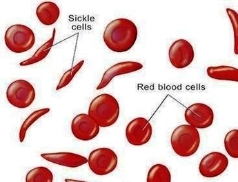 Sickle Cell Anemia Image