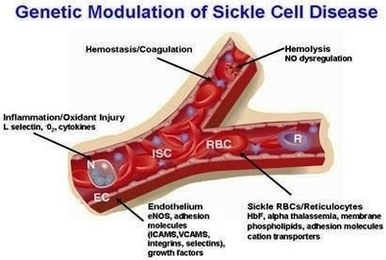Sickle Cell Disease Image
