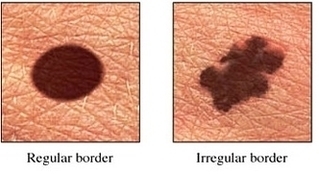 Skin Cancer Symptoms Image