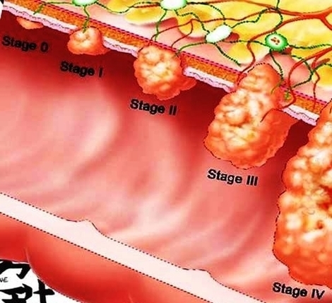 Stages Colon Cancer Image