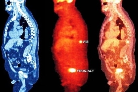 Stages Of Prostate Cancer Image