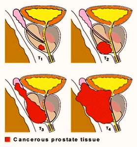 Stages Prostate Cancer Image