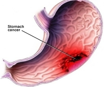 Stomach Cancer Tumor Image