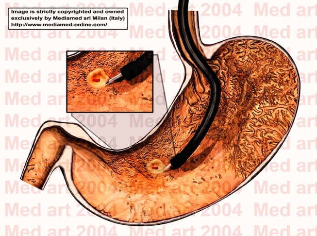 Stomach Ulcers Image