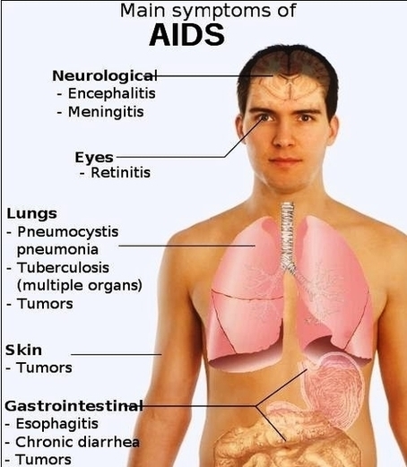 Symptoms Of Aids Diagram Image