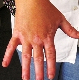 Symptoms Of Diabetes Skin Conditions Image