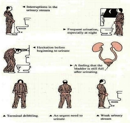 Symptoms Of Prostate Cancer Image