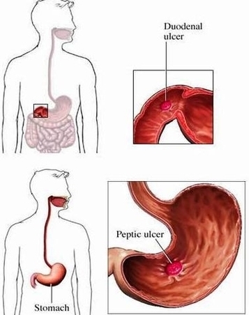 Symptoms Peptic Ulcers Image